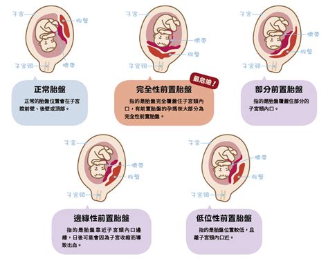 前置胎盤注意事項